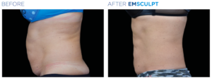 EMSCULPT