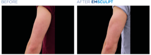 EMSCULPT