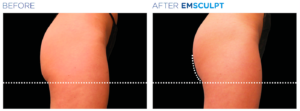 EMSCULPT