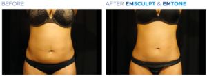 EMSCULPT