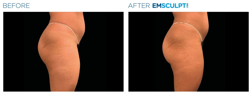 Emsculpt