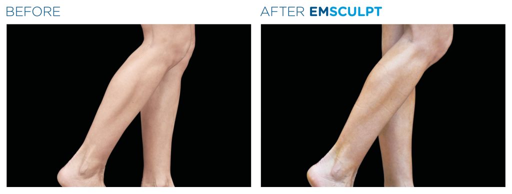 Emsculpt