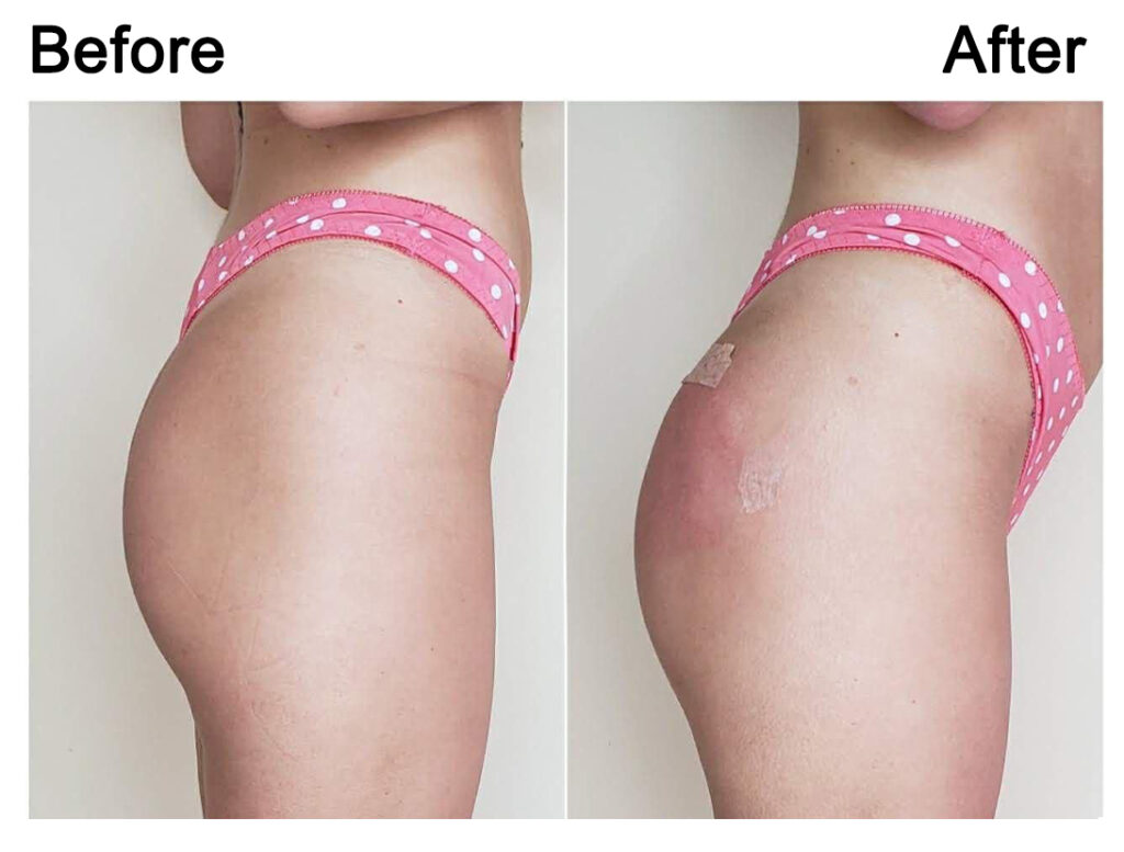 Non-Surgical BBL￼
