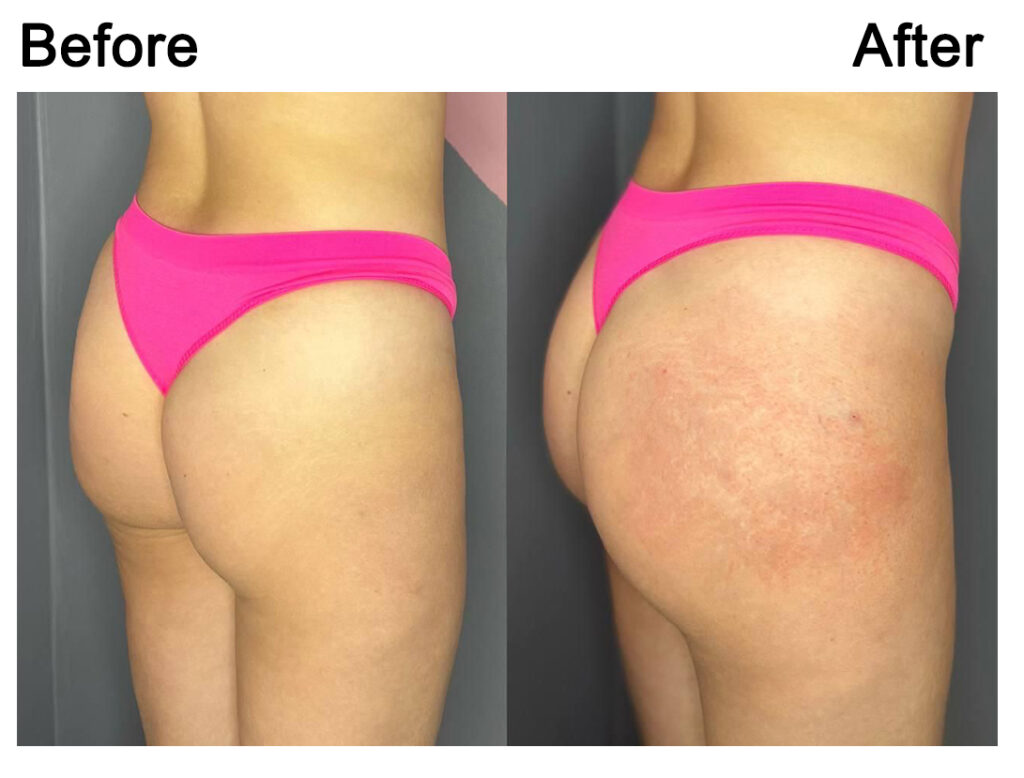 Non-Surgical BBL￼