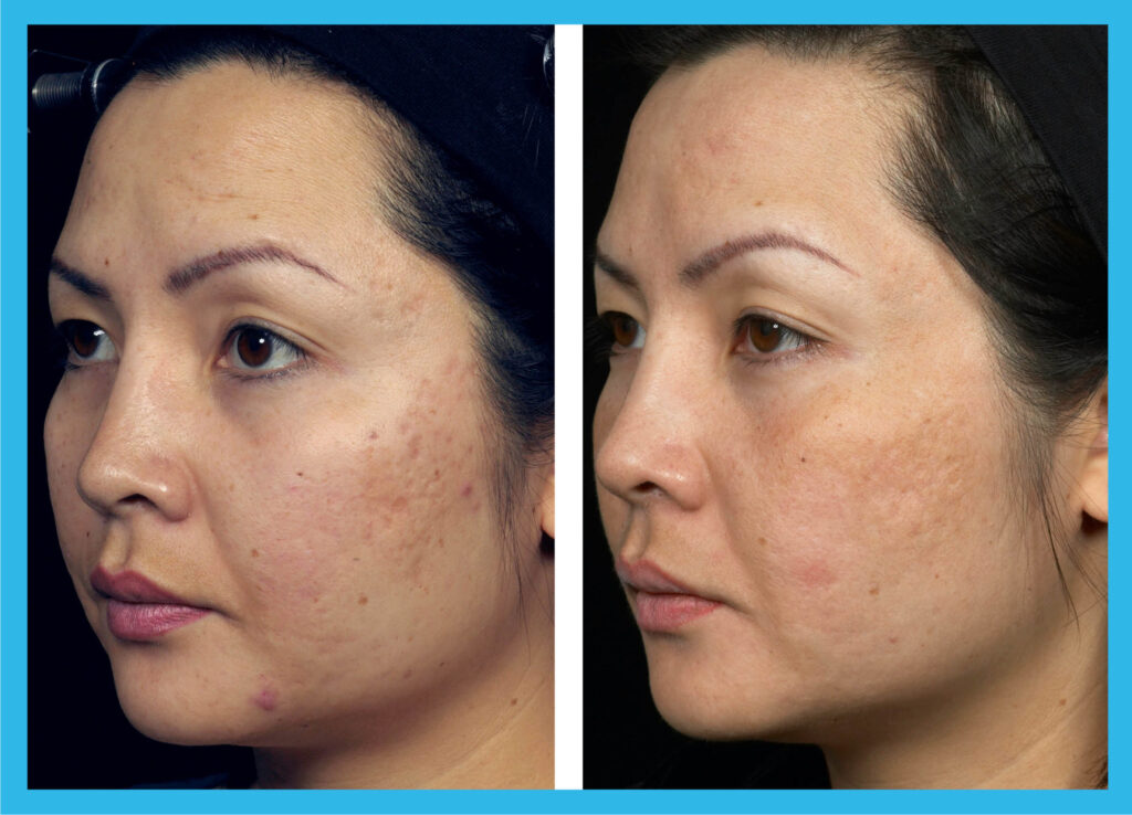 Cytocare Mesotherapy London