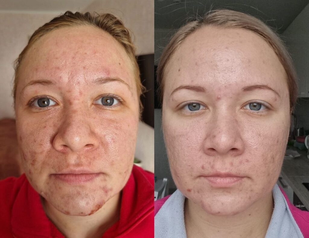 Microneedling London