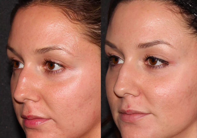 Microneedling London