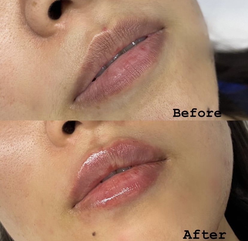 Lip Enhancement London Beauty Clinic