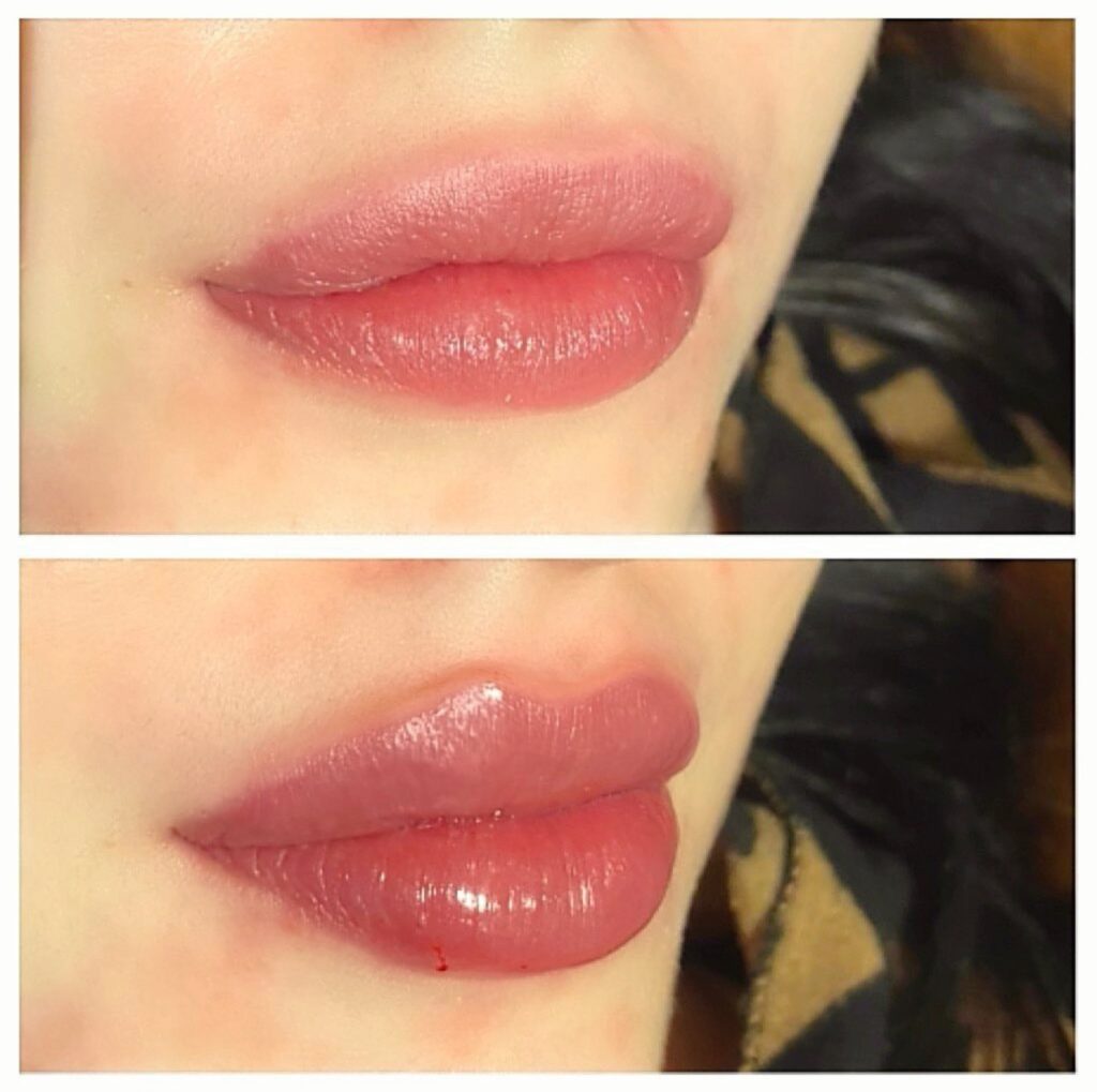 Lip Enhancement