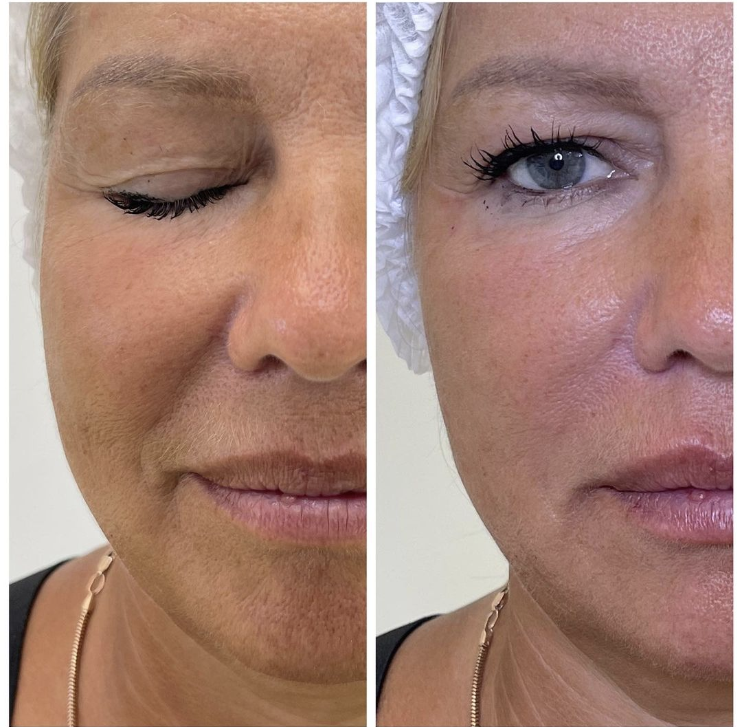 Nasolabial fold filler London Beauty Clinic
