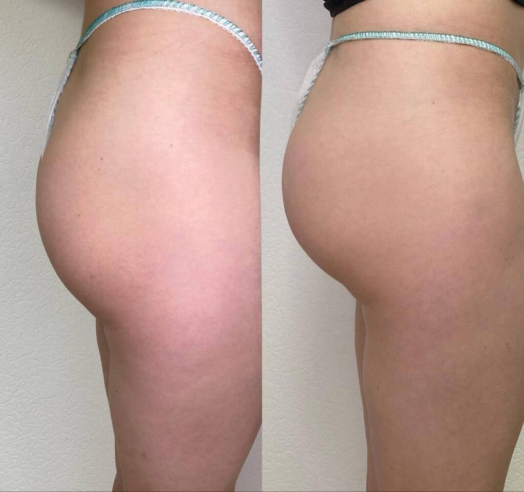 Non-Surgical BBL￼