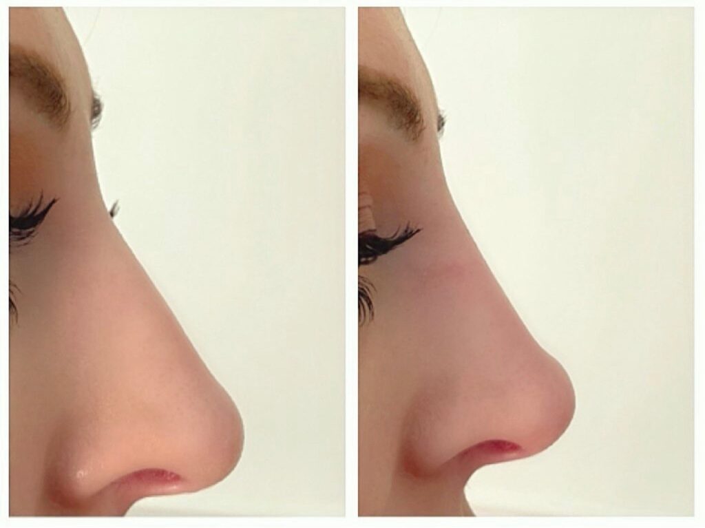 Nose Filler London Beauty Clinic
