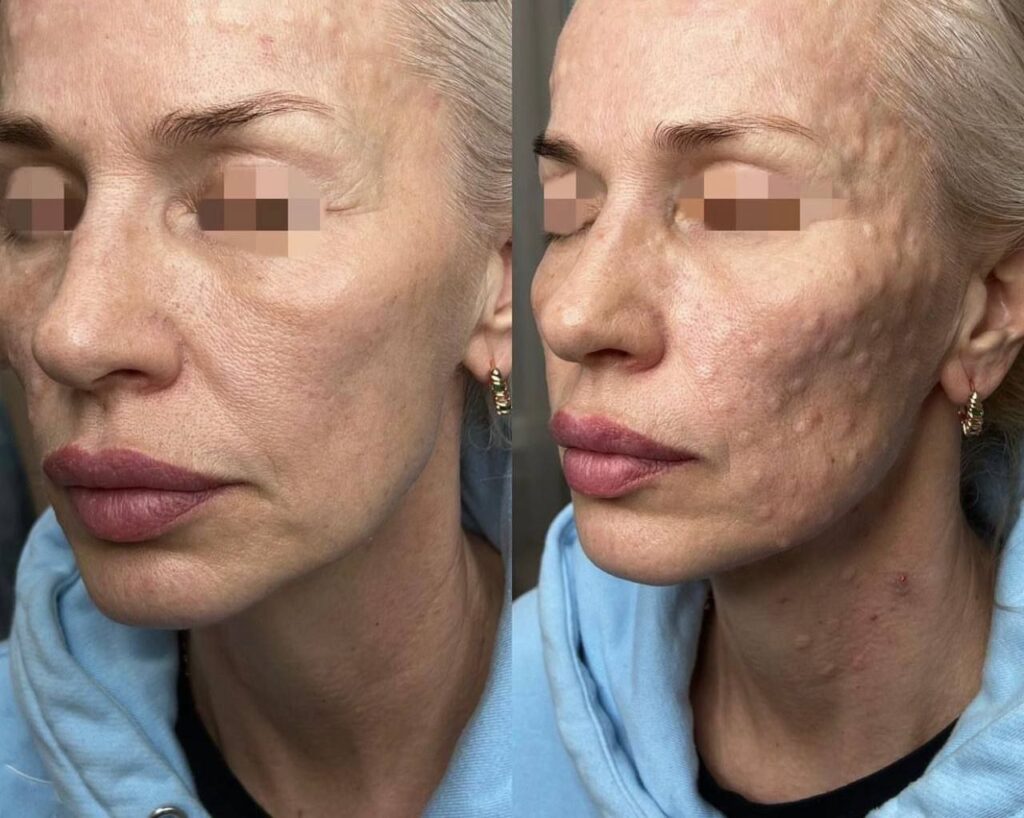 Cytocare Mesotherapy London