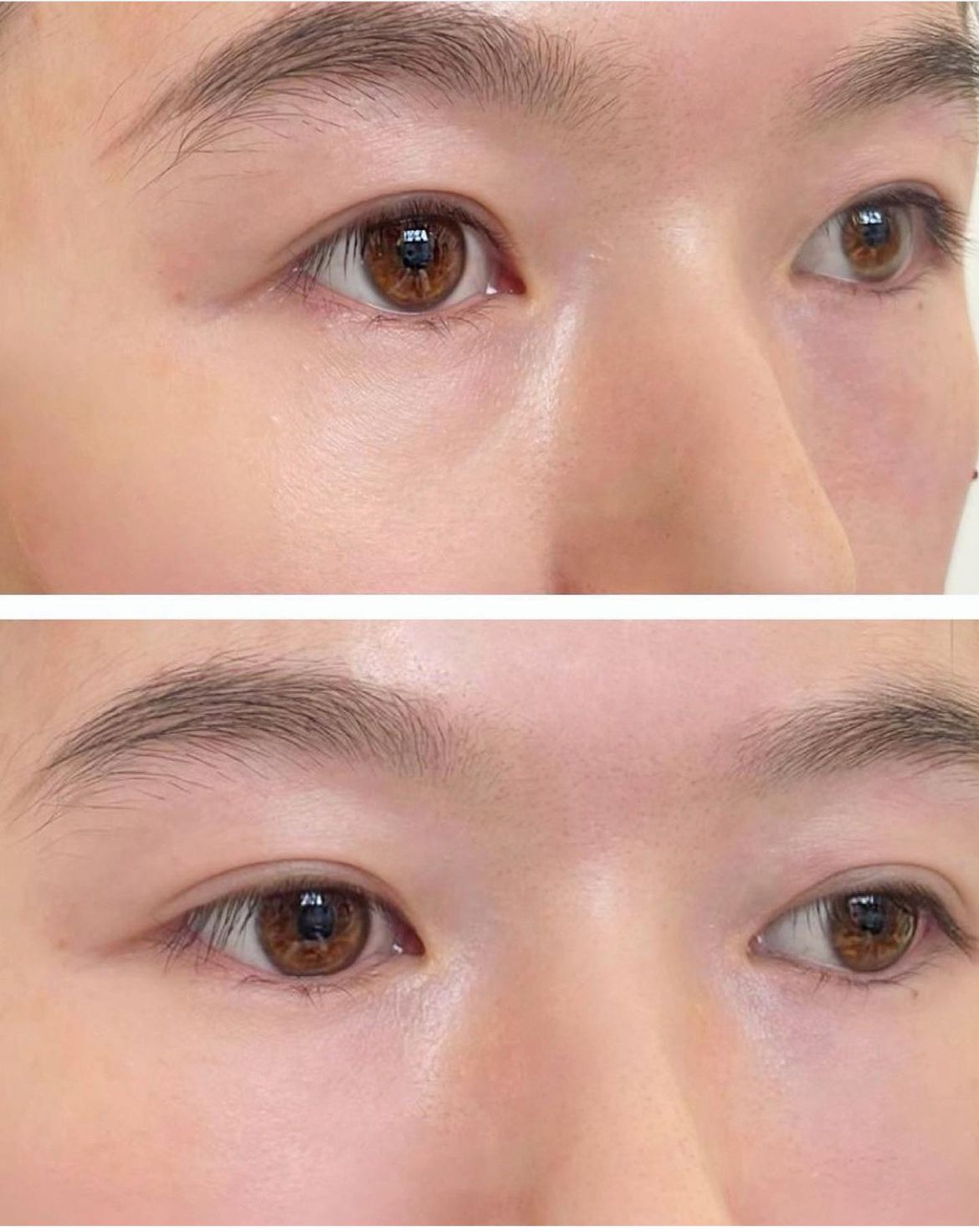 Tear Trough Treatment | Sunken Eye Treatment | Hollow Eyes Treatment