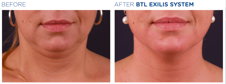 Exilis Ultra 360