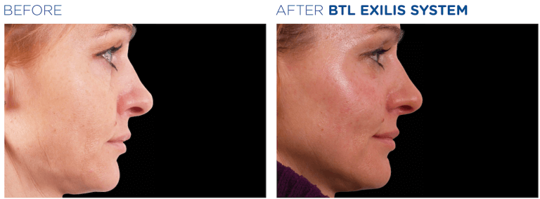 Exilis Ultra 360