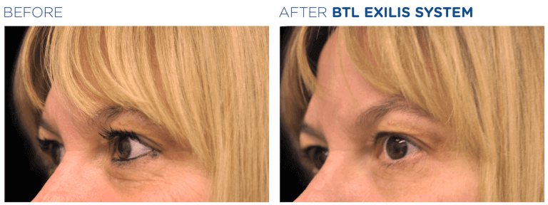 Exilis Ultra 360