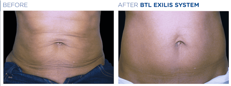 Exilis Ultra 360