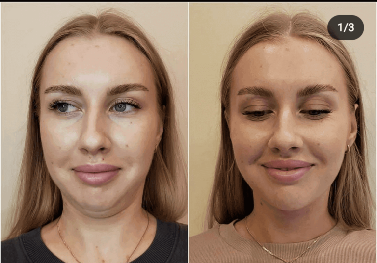masseter jawline slimming