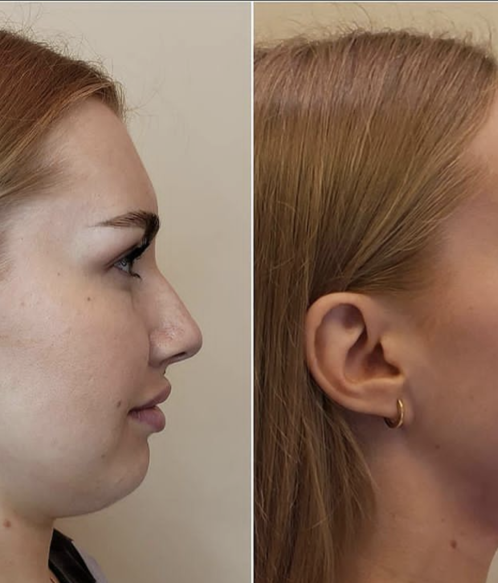 masseter_jawline_slimming_dr_mihaela